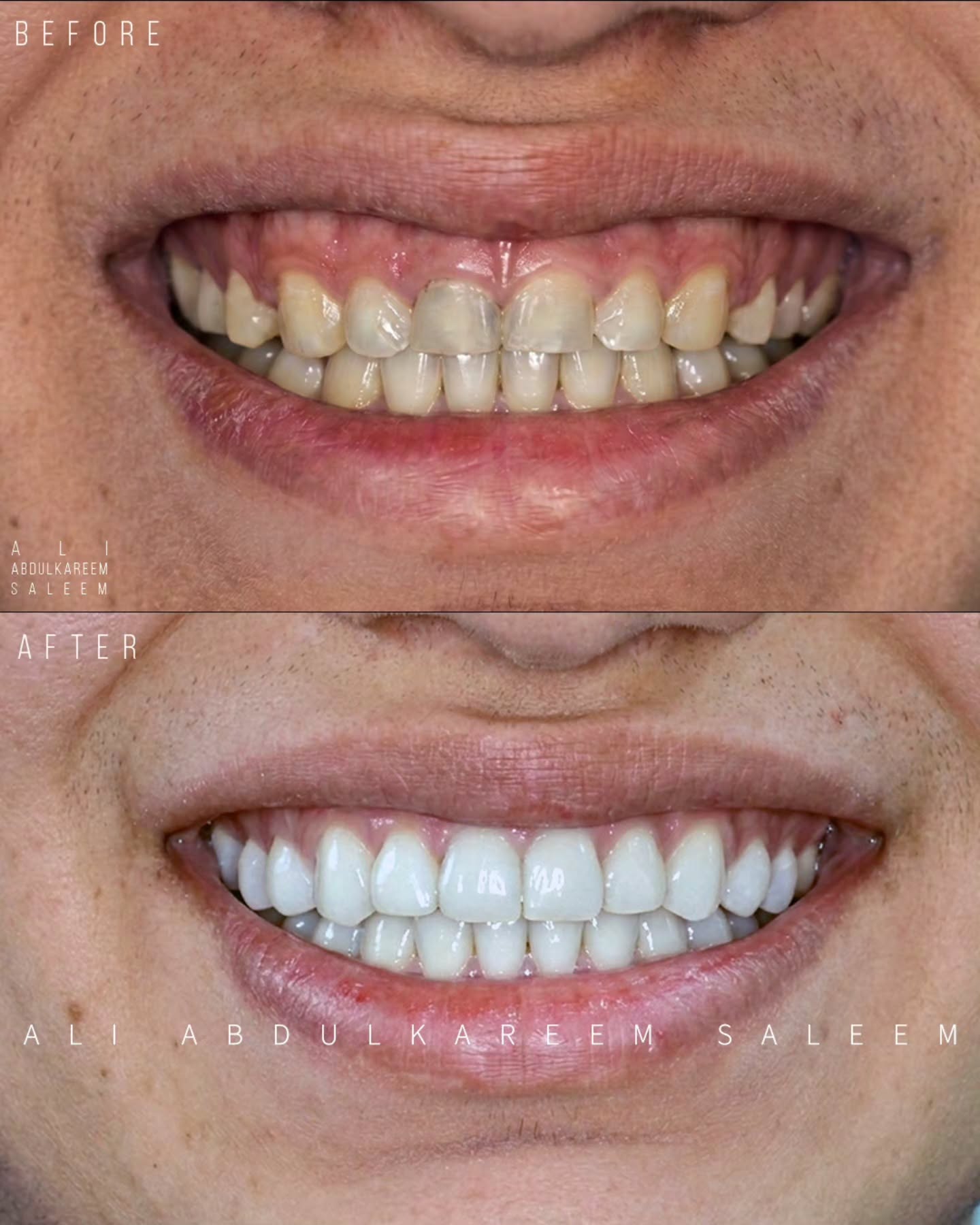 حالة تجميل الابتسامة قبل وبعد - ابتسامة هوليود... بقشور خزفية صحية ملائمة دائمية
د. علي عبدالكريم سليم | عيادة د. علي عبدالكريم سليم في الموصل