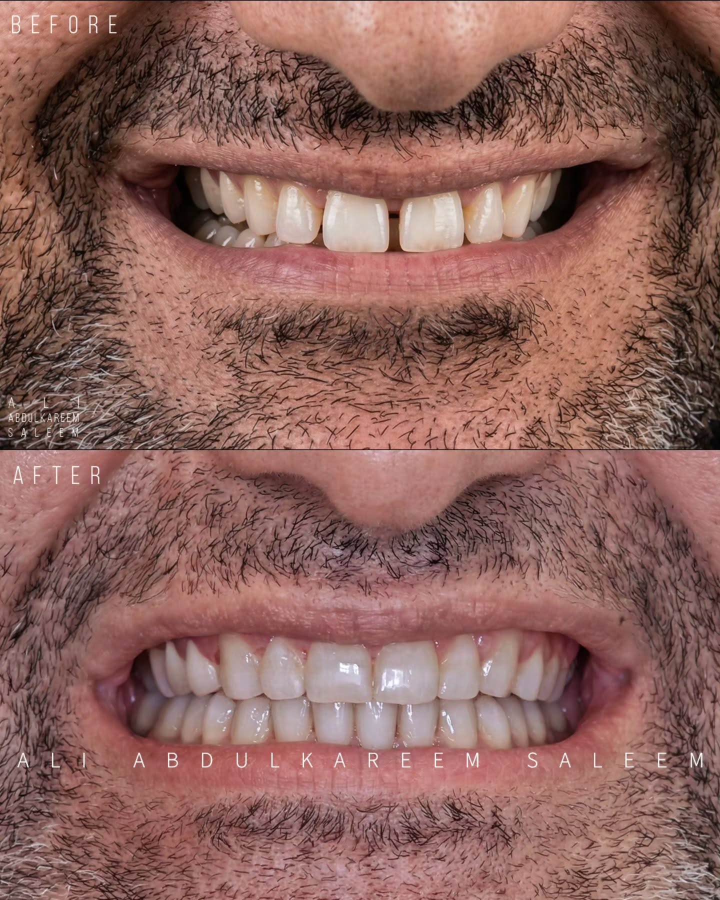 حالة تقويم الأسنان قبل وبعد - حالة تقويم لمراجع بالغ كان يعاني من تقدم الفك وعدم الرضا عن ابتسامته.
استغرقت الحالة سنة ونصف!
د. علي عبدالكريم سليم | عيادة د. علي عبدالكريم سليم في الموصل